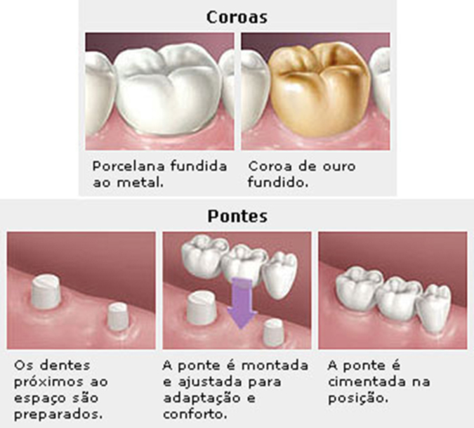 o_que_sao_coroas_e_pontes