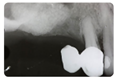 enxerto4