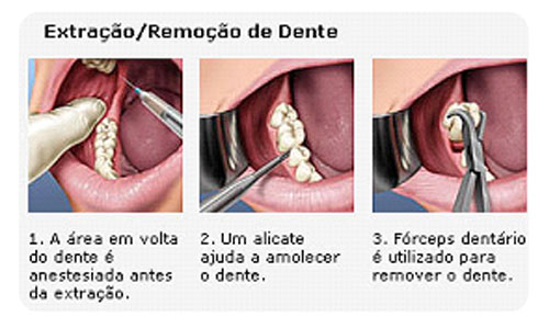 extracao