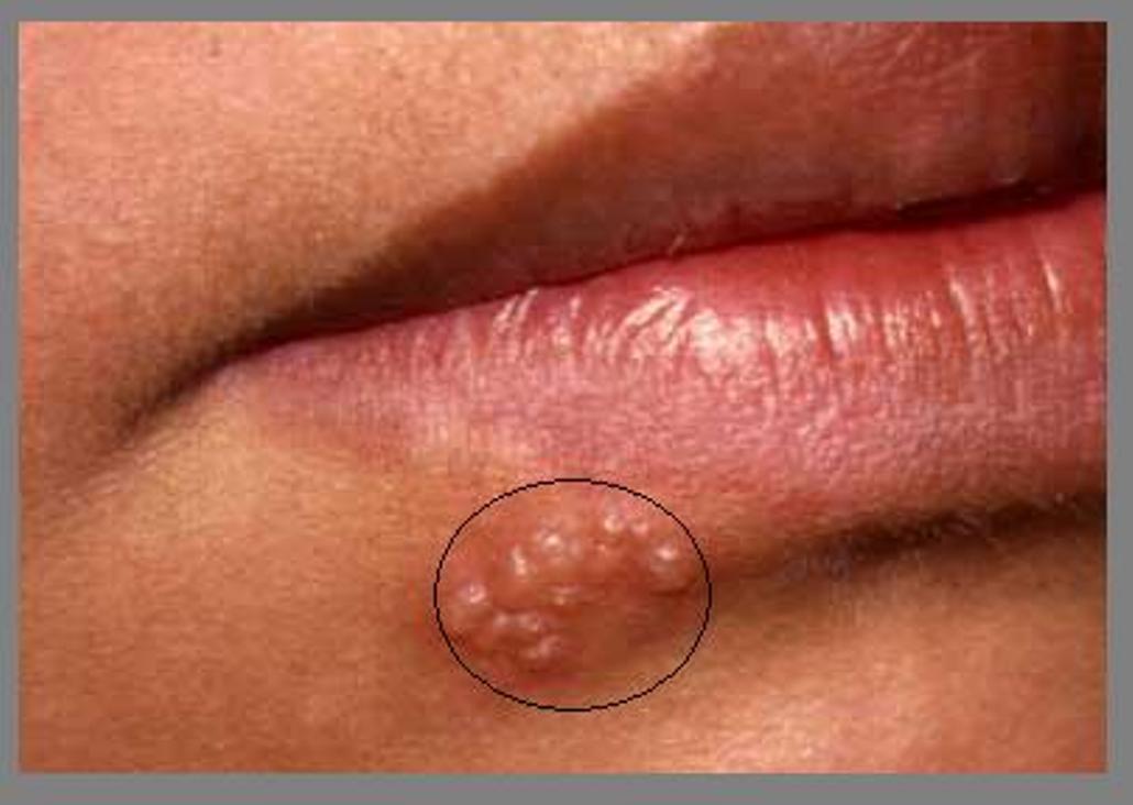 Herpes